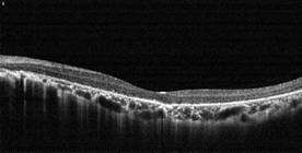 tomografia optica coherente retinitis pigmentosa